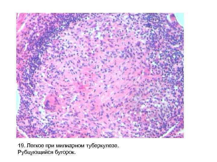 19. Легкое при милиарном туберкулезе. Рубцующийся бугорок. 