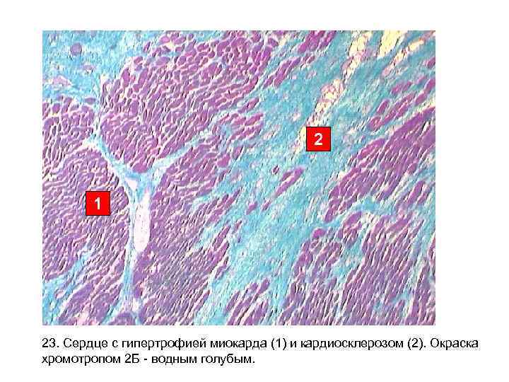        2  1 23. Сердце с гипертрофией