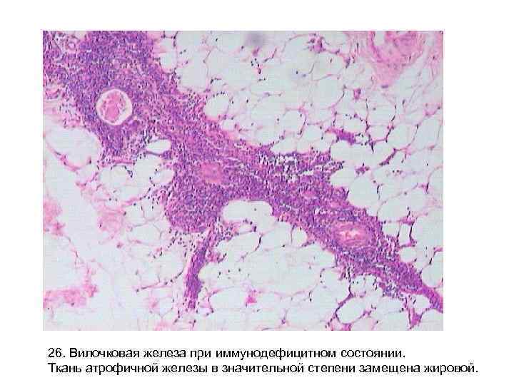 26. Вилочковая железа при иммунодефицитном состоянии. Ткань атрофичной железы в значительной степени замещена жировой.