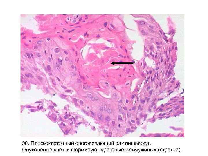 30. Плоскоклеточный ороговевающий рак пищевода. Опухолевые клетки формируют «раковые жемчужины» (стрелка). 