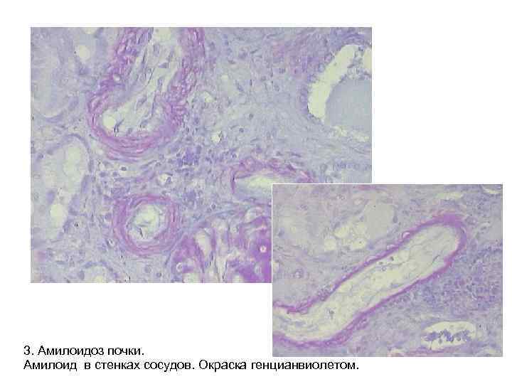 3. Амилоидоз почки. Амилоид в стенках сосудов. Окраска генцианвиолетом. 