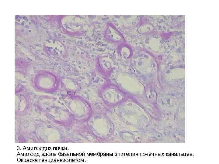3. Амилоидоз почки. Амилоид вдоль базальной мембраны эпителия почечных канальцев. Окраска генцианвиолетом. 