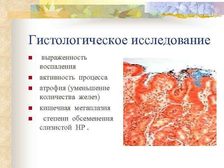 Гистологическое исследование n  выраженность  воспаления n  активность процесса n  атрофия