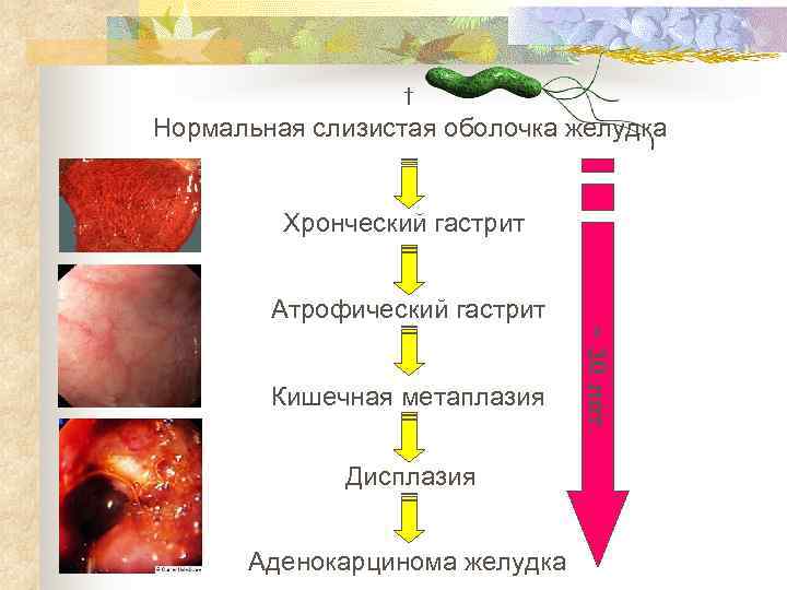    † Нормальная слизистая оболочка желудка  Хронческий гастрит  Атрофический гастрит