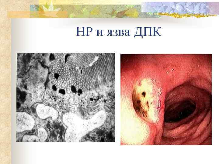   НР и язва ДПК n 