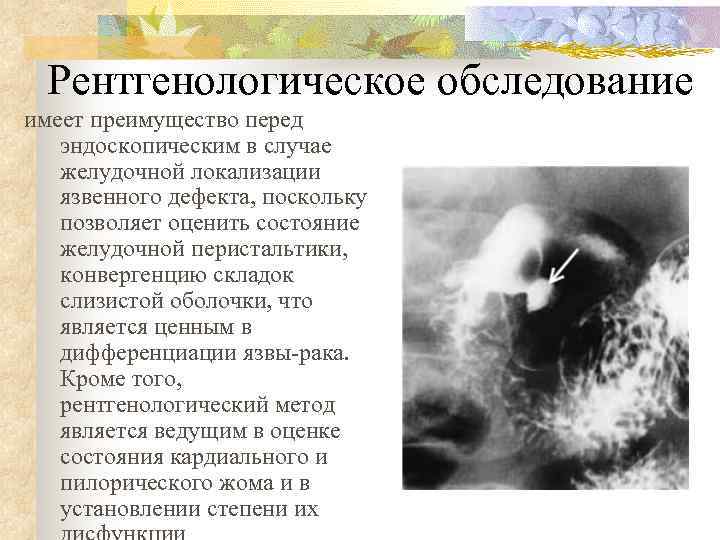  Рентгенологическое обследование имеет преимущество перед эндоскопическим в случае желудочной локализации язвенного дефекта, поскольку
