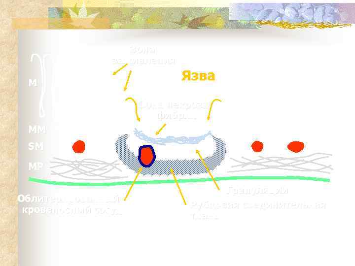    Зона   заживления  M    