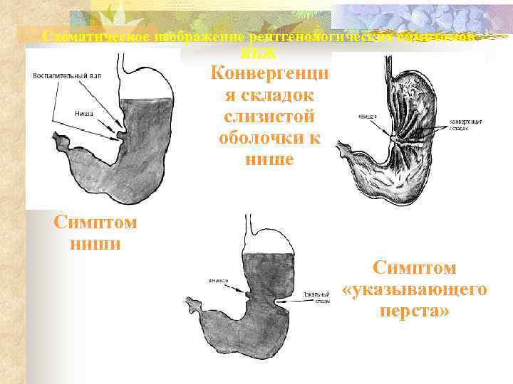 Схематическое изображение рентгенологических симптомов     ЯБЖ     Конвергенци