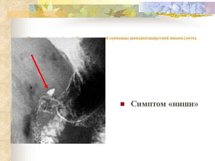 Рентгенограмма желудка больного с язвой луковицы двенадцатиперстной кишки (метод пневмографии)    