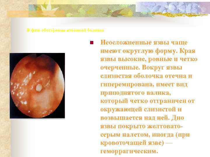 В фазе обострения язвенной болезни     n  Неосложненные язвы чаще