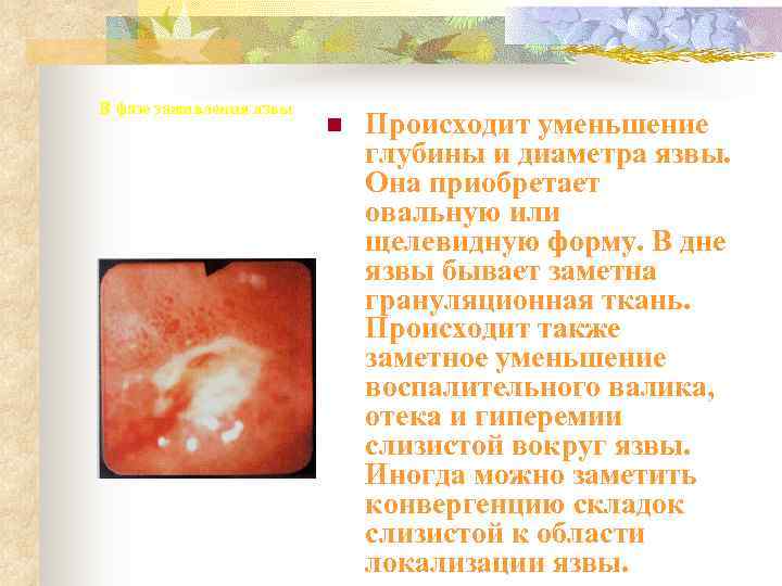 В фазе заживления язвы     n  Происходит уменьшение  