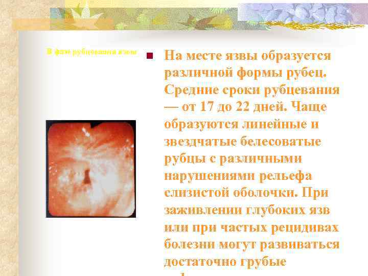 В фазе рубцевания язвы     n  На месте язвы образуется