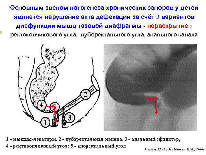 Основным звеном патогенеза хронических запоров у детей является нарушение акта дефекации за Основным звеном патогенеза хронических запоров у детей является нарушение акта дефекации за
