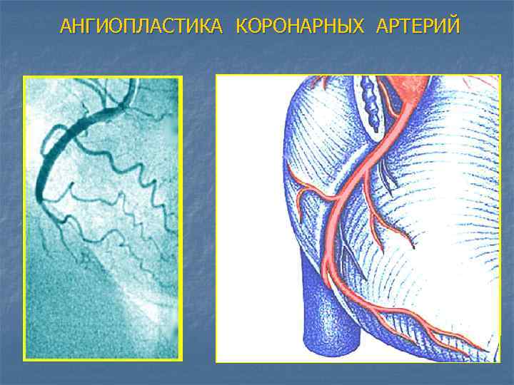 АНГИОПЛАСТИКА КОРОНАРНЫХ АРТЕРИЙ 