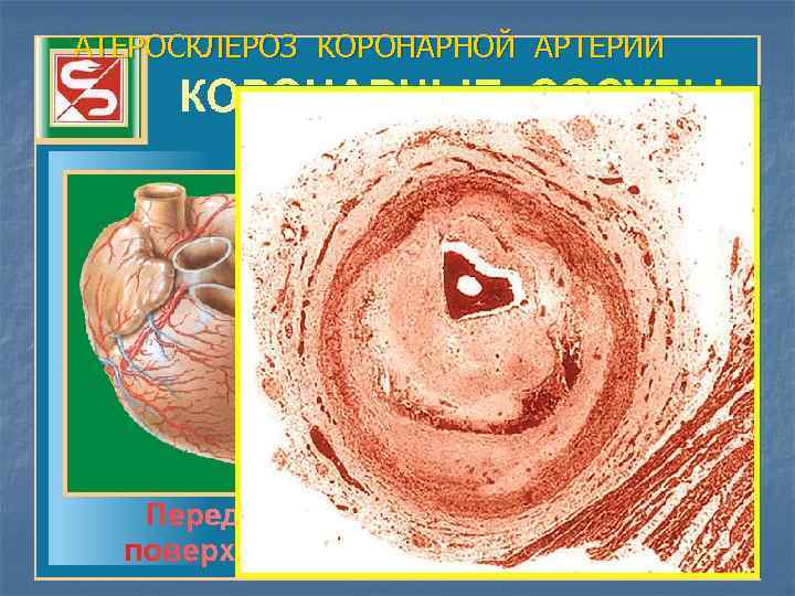 АТЕРОСКЛЕРОЗ КОРОНАРНОЙ АРТЕРИИ 