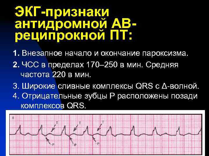 Сливной экс. Псевдосливные комплексы на ЭКГ. Сливные желудочковые комплексы на ЭКГ. Псевдосливные желудочковые комплексы.