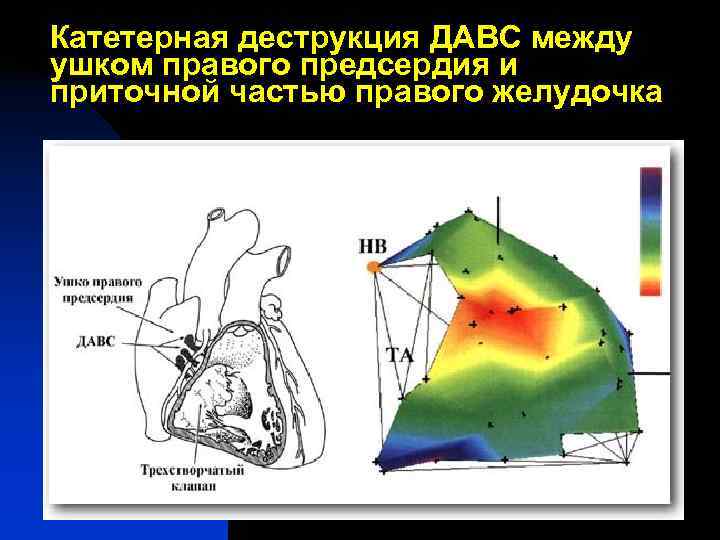 Катетерная деструкция ДАВС между ушком правого предсердия и приточной частью правого желудочка 