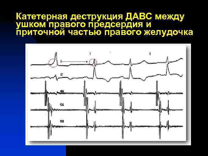 Катетерная деструкция ДАВС между ушком правого предсердия и приточной частью правого желудочка 
