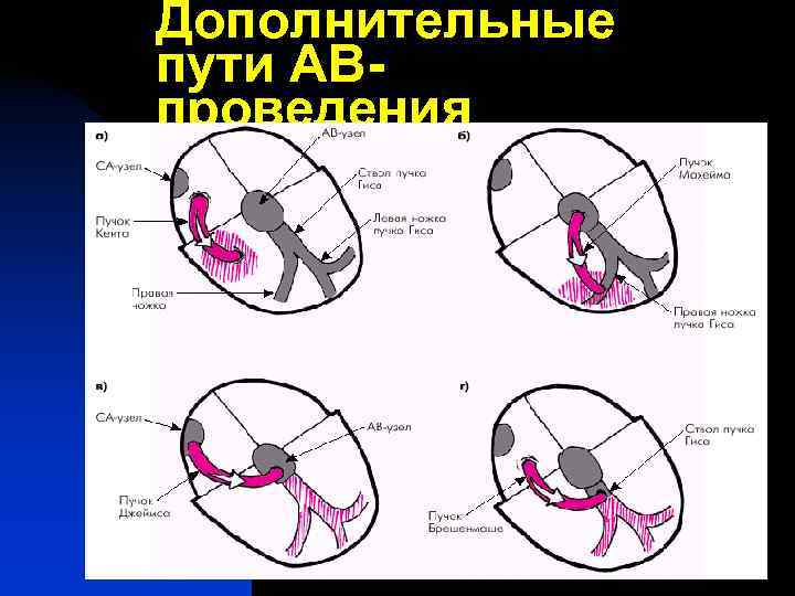 Дополнительный путь. Дополнительные пути проведения. Добавочные пути проведения сердца. Дополнительные проводящие пути сердца. Дополнительные пути проведения на ЭКГ.