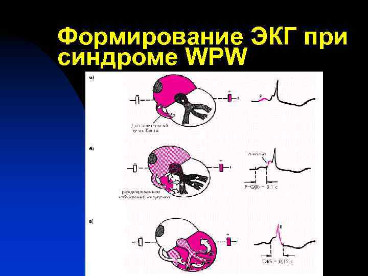 Формирование ЭКГ при синдроме WPW 