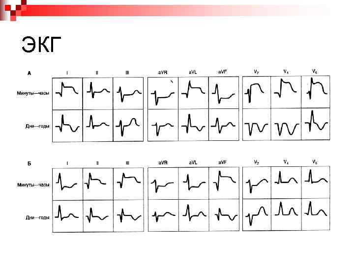 ЭКГ 