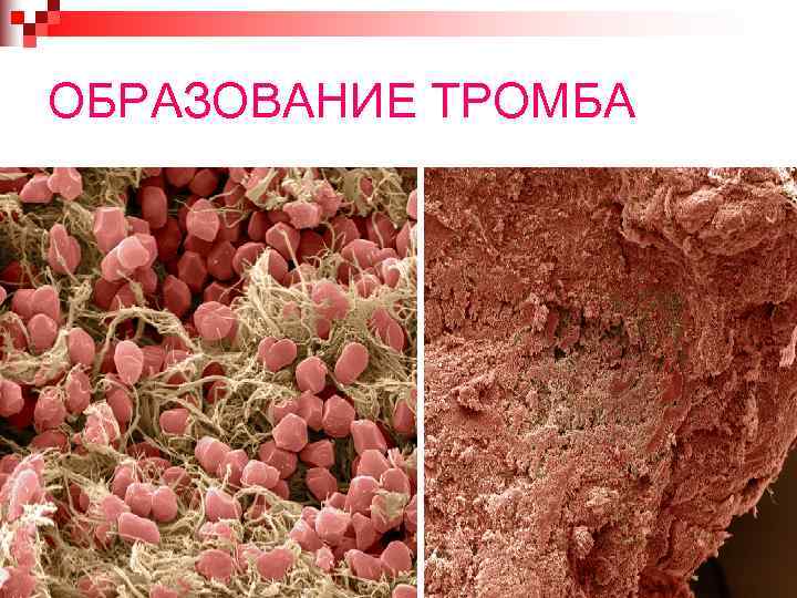 ОБРАЗОВАНИЕ ТРОМБА 