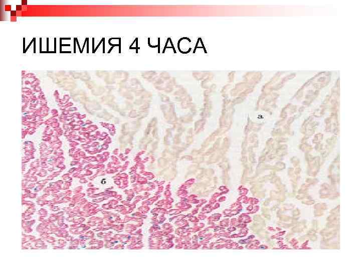 ИШЕМИЯ 4 ЧАСА 