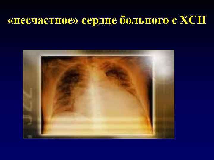  «несчастное» сердце больного с ХСН 