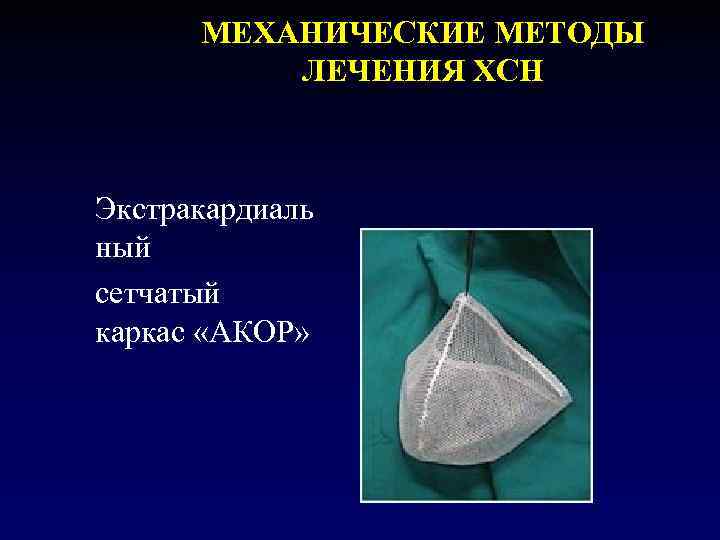  МЕХАНИЧЕСКИЕ МЕТОДЫ  ЛЕЧЕНИЯ ХСН  Экстракардиаль ный сетчатый каркас «АКОР» 