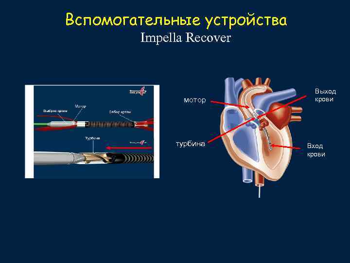 Вспомогательные устройства   Impella Recover      Выход  