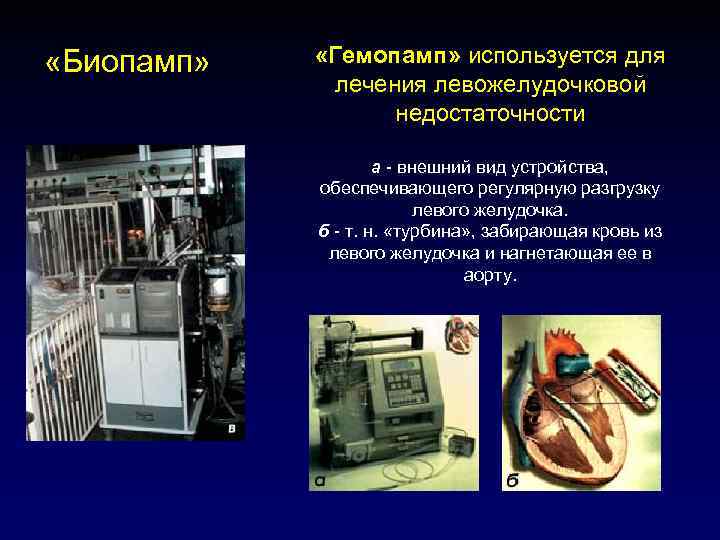  «Биопамп» «Гемопамп» используется для    лечения левожелудочковой    недостаточности