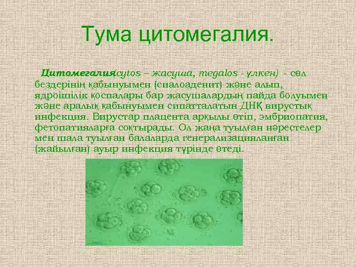   Тума цитомегалия.  Цитомегалия  (cytos – жасуша, megalos - үлкен) -