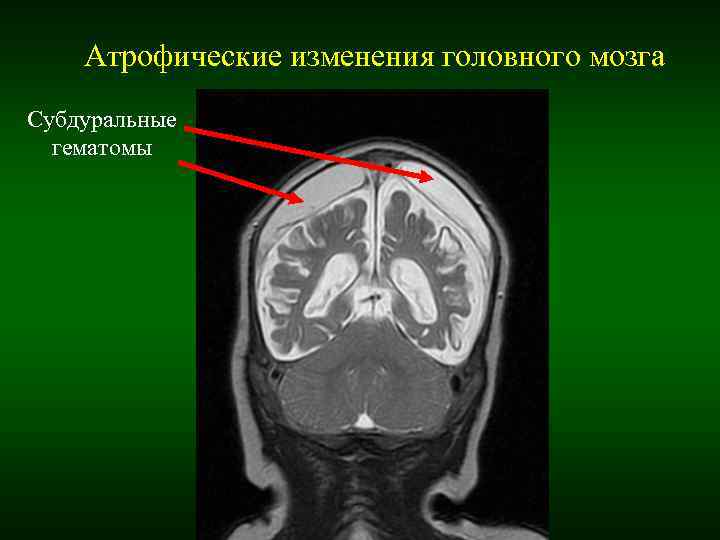 Атрофические изменения головного мозга Субдуральные гематомы Атрофические изменения головного мозга Субдуральные гематомы