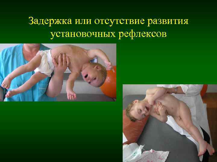 Задержка или отсутствие развития установочных рефлексов Задержка или отсутствие развития установочных рефлексов