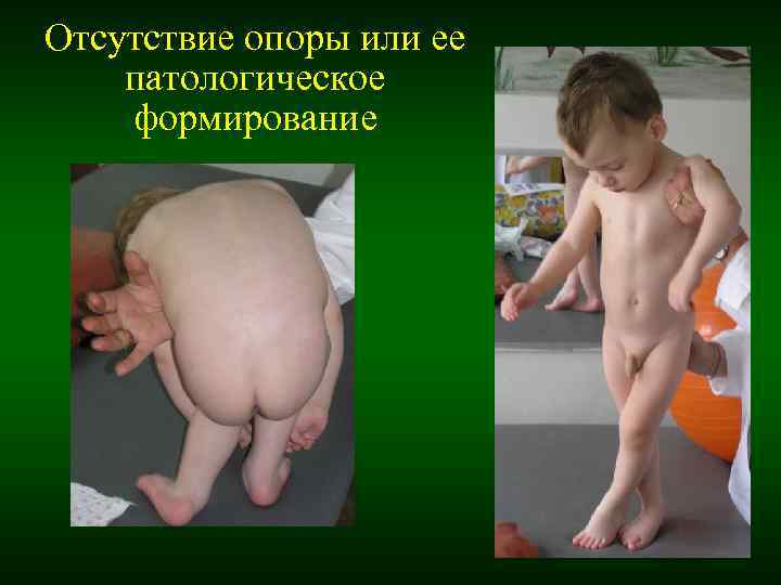 Отсутствие опоры или ее патологическое формирование Отсутствие опоры или ее патологическое формирование