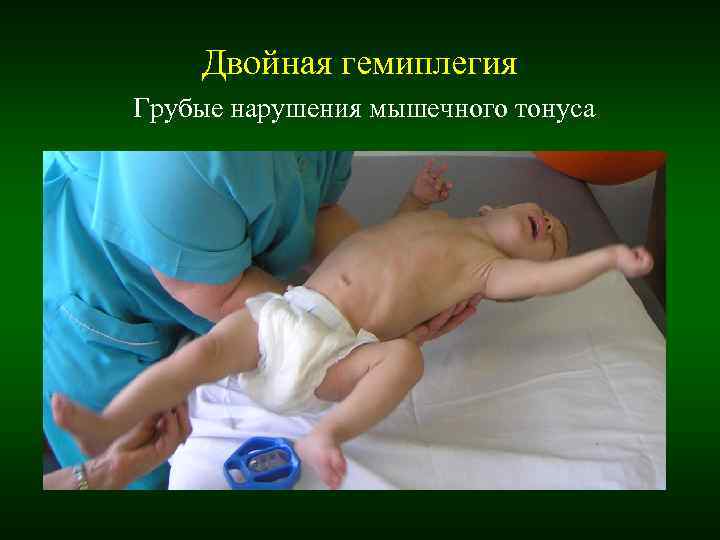 Двойная гемиплегия Грубые нарушения мышечного тонуса Двойная гемиплегия Грубые нарушения мышечного тонуса