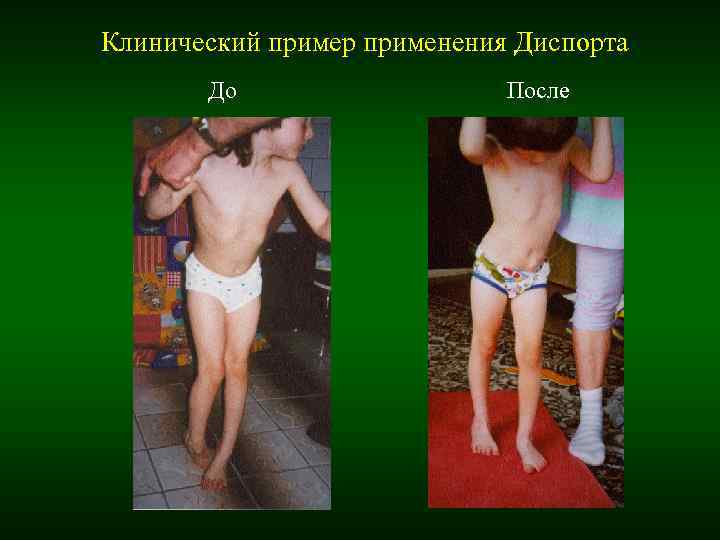 Клинический пример применения Диспорта До После Клинический пример применения Диспорта До После