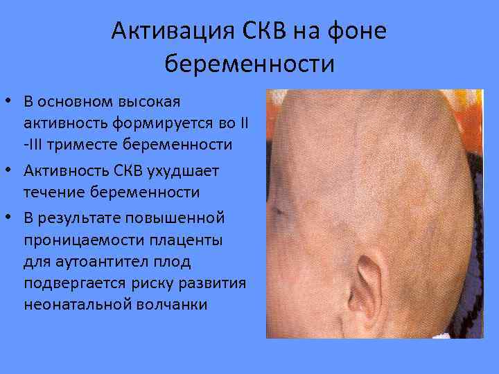    Активация СКВ на фоне   беременности • В основном высокая