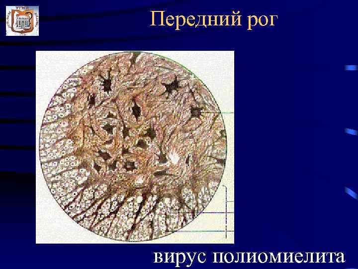 Передний рог вирус полиомиелита 