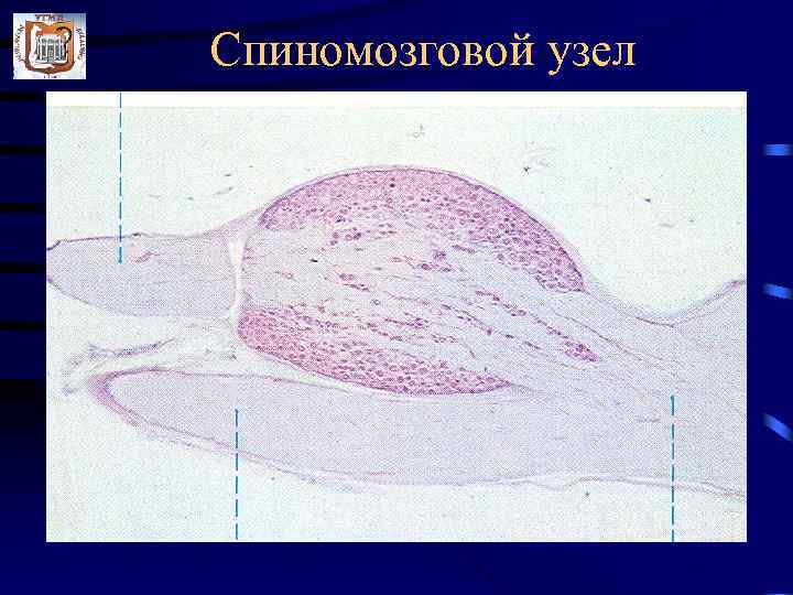 Спиномозговой узел 