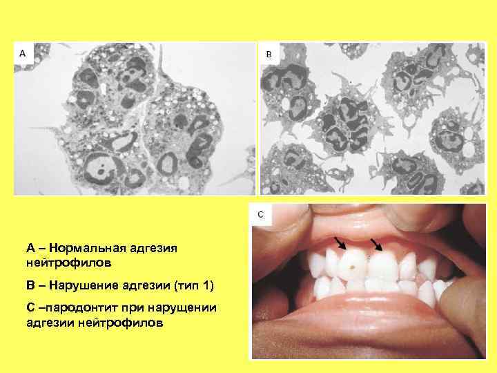 А – Нормальная адгезия нейтрофилов В – Нарушение адгезии (тип 1) С –пародонтит при А – Нормальная адгезия нейтрофилов В – Нарушение адгезии (тип 1) С –пародонтит при
