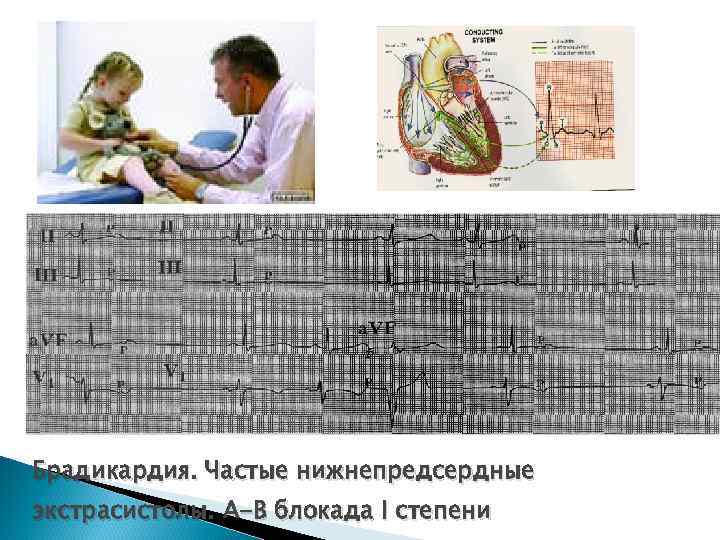 Брадикардия. Частые нижнепредсердные экстрасистолы. А-В блокада I степени 