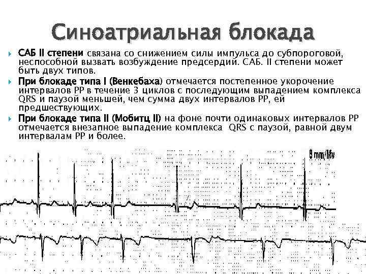 Синоатриальная блокада мкб