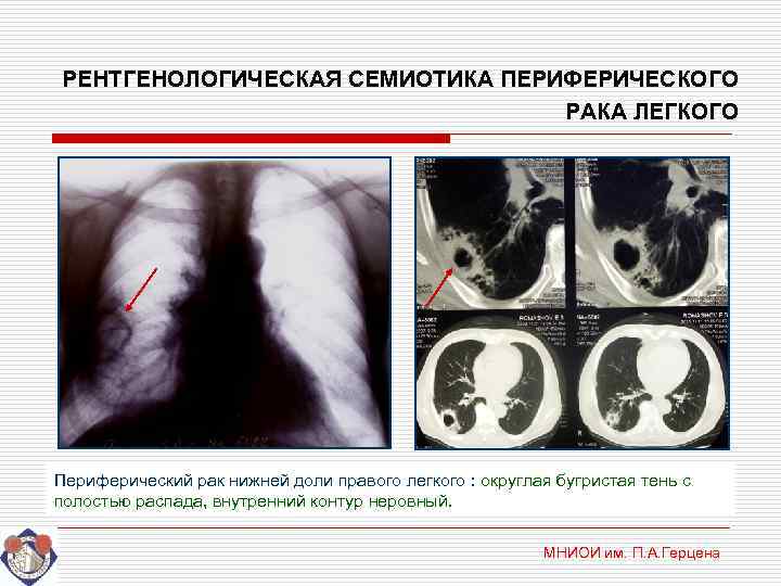 РЕНТГЕНОЛОГИЧЕСКАЯ СЕМИОТИКА ПЕРИФЕРИЧЕСКОГО       РАКА ЛЕГКОГО Периферический рак нижней