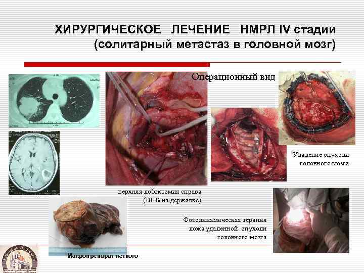 ХИРУРГИЧЕСКОЕ ЛЕЧЕНИЕ НМРЛ IV стадии (солитарный метастаз в головной мозг)    Операционный