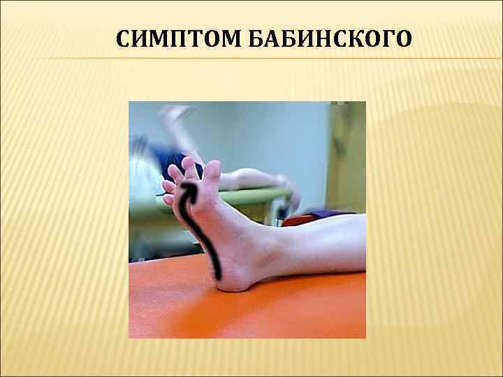 СИМПТОМ БАБИНСКОГО 