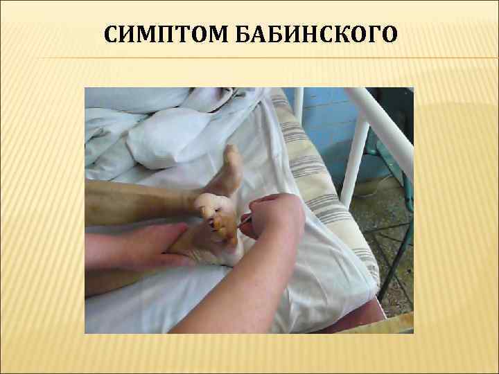 СИМПТОМ БАБИНСКОГО 