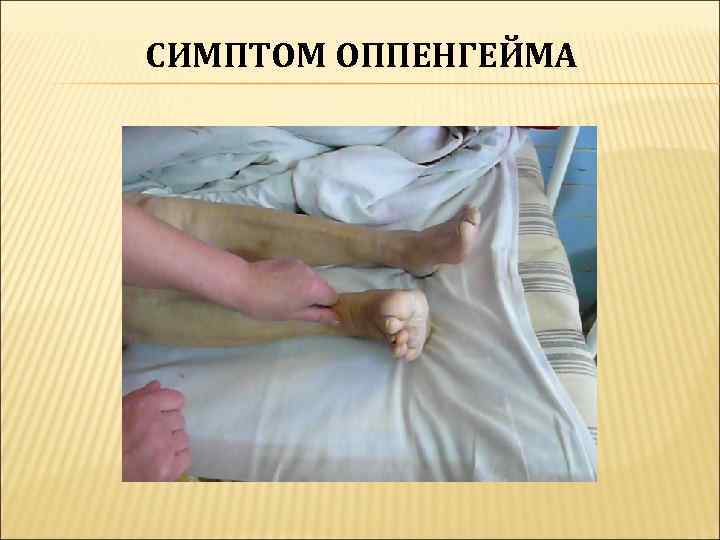 СИМПТОМ ОППЕНГЕЙМА 