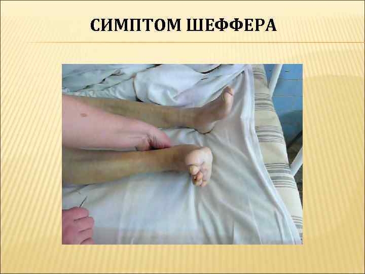 СИМПТОМ ШЕФФЕРА 