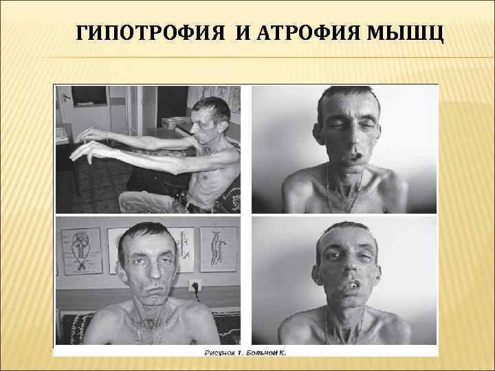 ГИПОТРОФИЯ И АТРОФИЯ МЫШЦ 